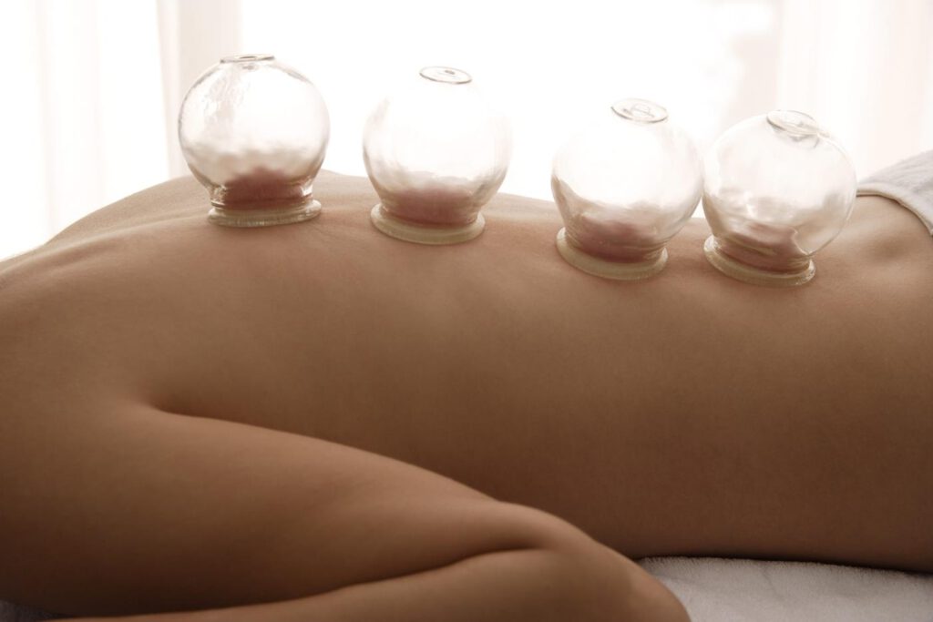 Wat is cupping therapie